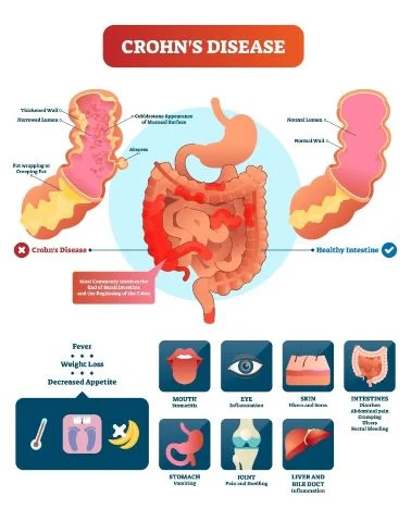 Beating Crohn’s Disease With Nutrition